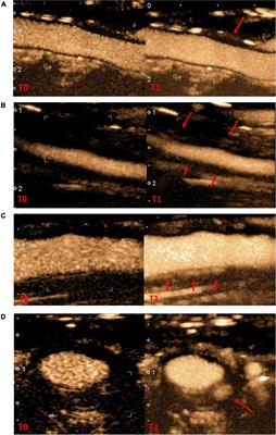 Inter and intra-observer agreement of arterial wall contrast-enhanced ultrasonography in giant cell arteritis